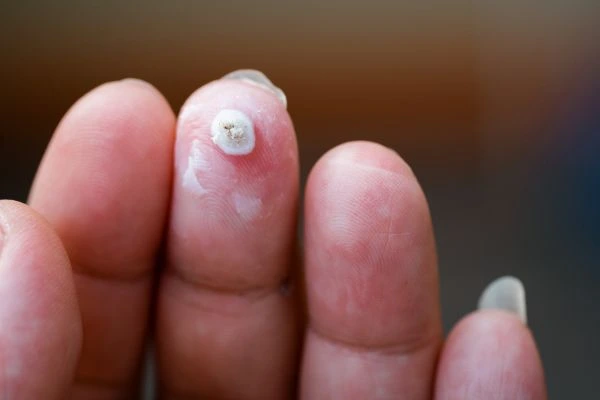 wart on person finger - cryotherapy to treat from LA LIPO Canning Town